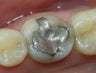 Patient Receives Composite Filling