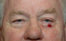 Left lower eyelid skin defect