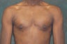 Male Breast Reduction