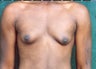 Male Breast Reduction