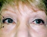 Female undergoes brow and eyelid lift to attain a more youthful look