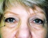 Female undergoes brow and eyelid lift to attain a more youthful look