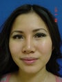 Rhinoplasty