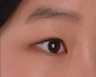 Double eyelid surgery should be taken with forehead & eyebrow lift