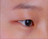 Double eyelid surgery should be taken with forehead & eyebrow lift