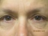 Eyelid Surgery