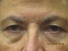Eyelid Surgery