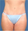 Body contouring 