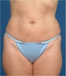 Body contouring 