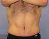 Tummy Tuck