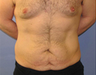 Tummy Tuck