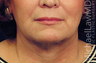 Lower Facial Rejuvenation: Neck Lift