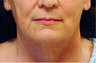 Lower Facial Rejuvenation: Neck Lift
