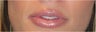 Lip Augmentation