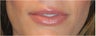 Lip Augmentation