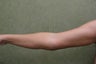 Arm Lift