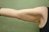 Arm Lift
