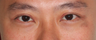 Double Eyelid Surgery (Asian Blepharoplasty), Vancouver, B.C.