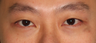 Double Eyelid Surgery (Asian Blepharoplasty), Vancouver, B.C.