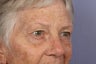 63 yr old Eyelid Surgery