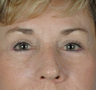 Endoscopic Brow Lift