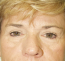 Endoscopic Brow Lift