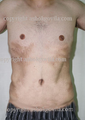 Male Tummy Tuck
