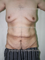 Male Tummy Tuck