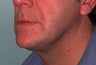 55 year old male patient 