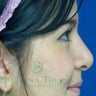 Rhinoplasty or Nose Surgery