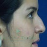 Rhinoplasty or Nose Surgery