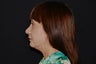 Chin Augmentation