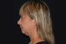 Chin Augmentation