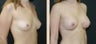 Breast Augmentation