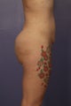 Butt Augmentation