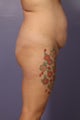 Butt Augmentation