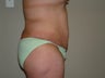 Abdominoplasty