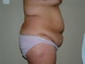 Abdominoplasty