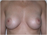 Breast Implants