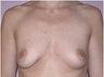 Breast Implants