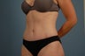 Tummy Tuck