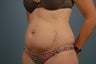 Tummy Tuck