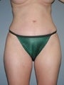 Female patient who underwent a tummy tuck 