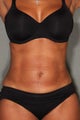 54 Year Old Female Treated for UnWanted Fat With SmartLipo and Vaser Laser High Deffinition 