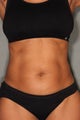 54 Year Old Female Treated for UnWanted Fat With SmartLipo and Vaser Laser High Deffinition 