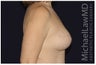 Mastopexy