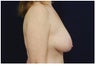 Mastopexy