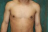 Male Breast Reduction