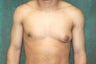 Male Breast Reduction
