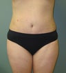 Mini Abdominoplasty with Liposuction of Flanks